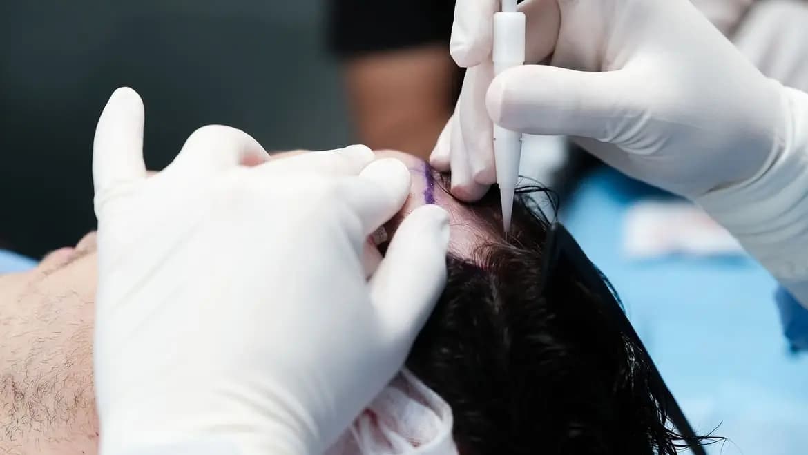 Tecnica DHI - Penna Choi